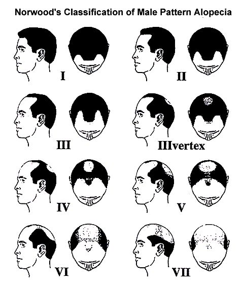 Norwood Hair Loss Classification Chart